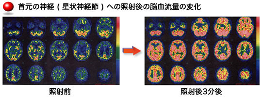 正常神経節照射後の脳血流の変化